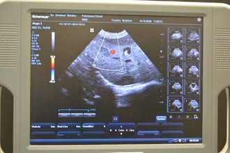 Leberuntersuchung mit der Doppler-Sonographie